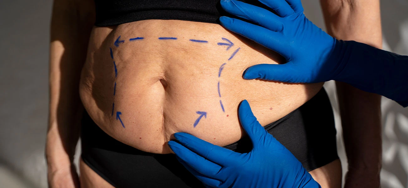 Clinical assessment markings for bariatric and abdominal surgery