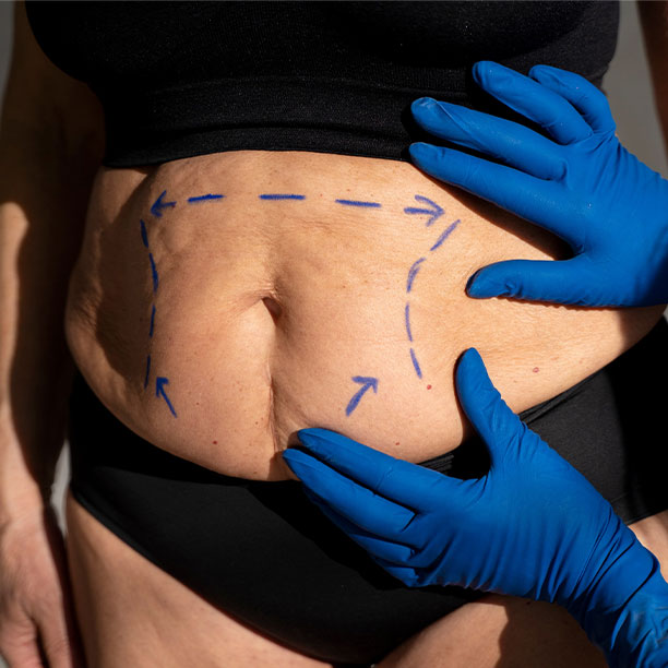 Bariatric Surgery