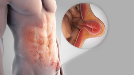 Medical illustration showing an inguinal hernia in the groin